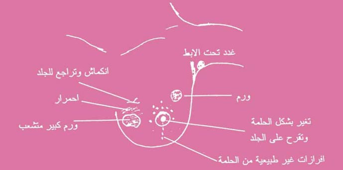 رسم بياني عن سرطان الثدي في مدن المملكة رسم العين