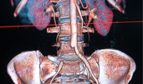 Successful Carotid Artery Surgery to 70-Year-Old Saudi Patient
