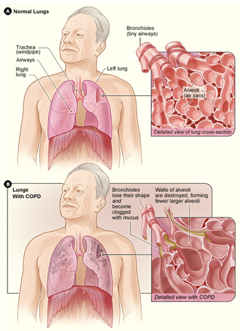 COPD 2.png